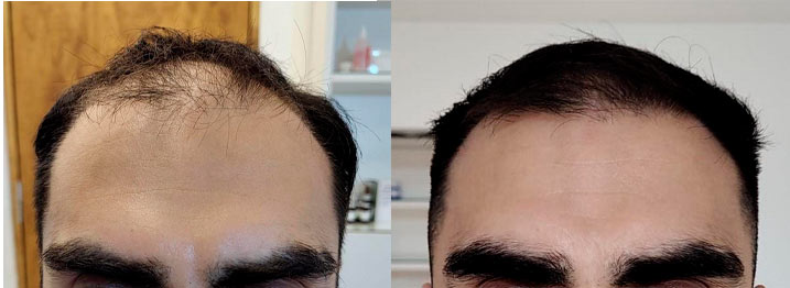 Antes y después de 6 sesiones de mesoterapia capilar